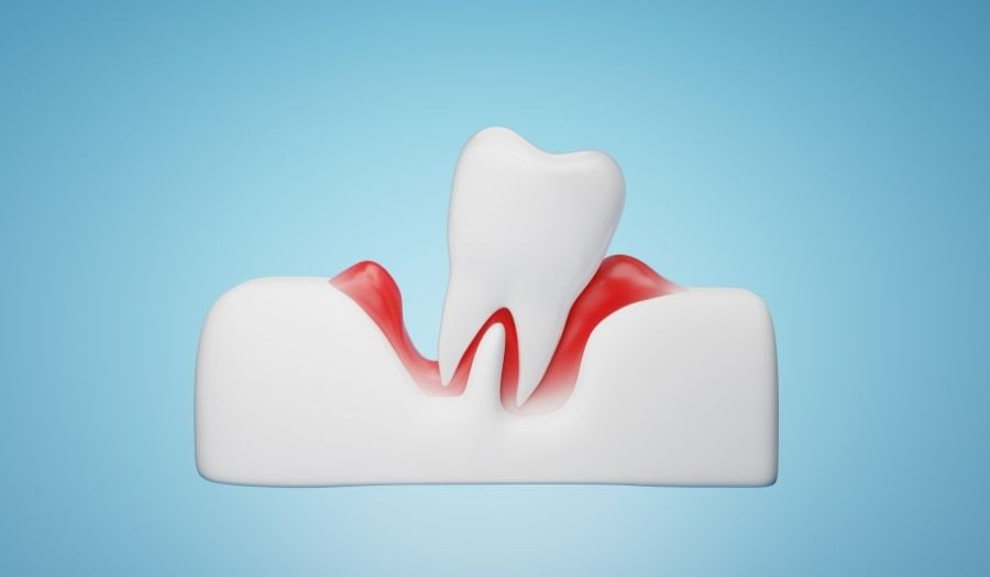 Dişeti Hastalıkları Tedavisi