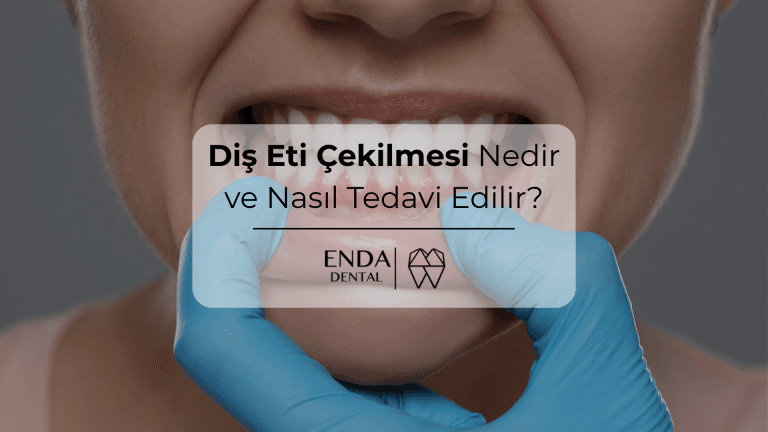 Diş Eti Çekilmesi Nedir ve Nasıl Tedavi Edilir?