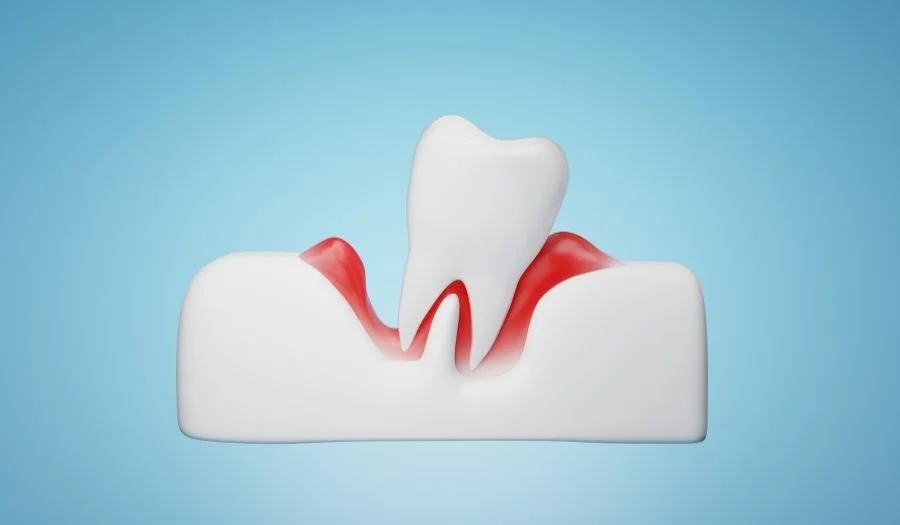 Diş eti çekilmesi nedir ve nasıl tedavi edilir?